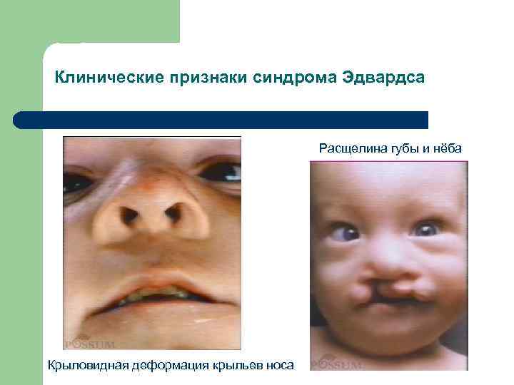 Клинические признаки синдрома Эдвардса Расщелина губы и нёба Крыловидная деформация крыльев носа 
