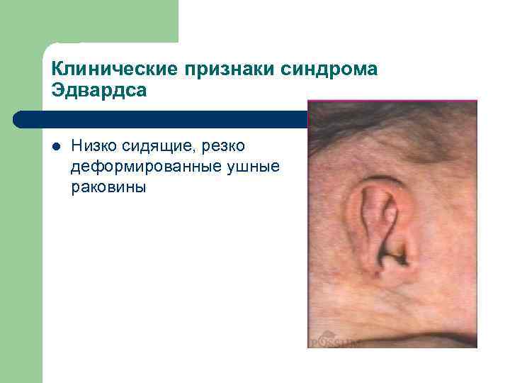 Клинические признаки синдрома Эдвардса l Низко сидящие, резко деформированные ушные раковины 