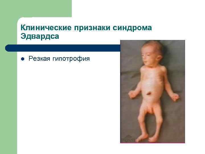 Клинические признаки синдрома Эдвардса l Резкая гипотрофия 