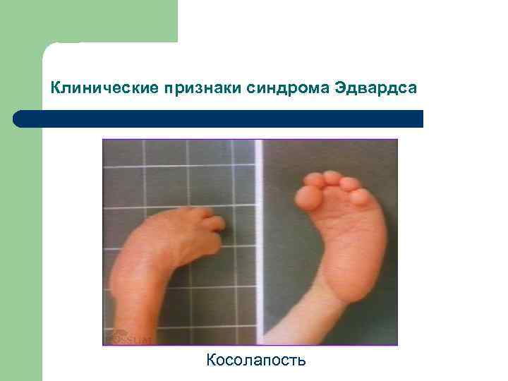 Клинические признаки синдрома Эдвардса Косолапость 