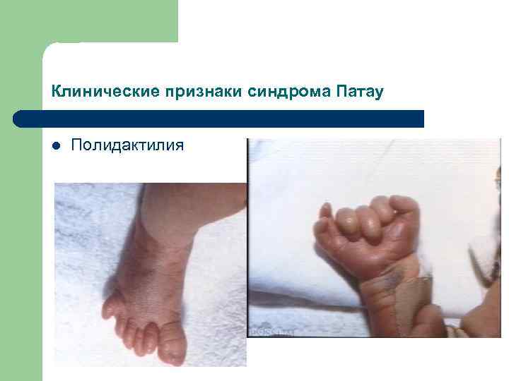 Клинические признаки синдрома Патау l Полидактилия 