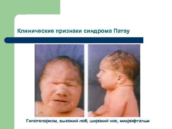 Клинические признаки синдрома Патау Гипотелоризм, высокий лоб, широкий нос, микрофтальм 