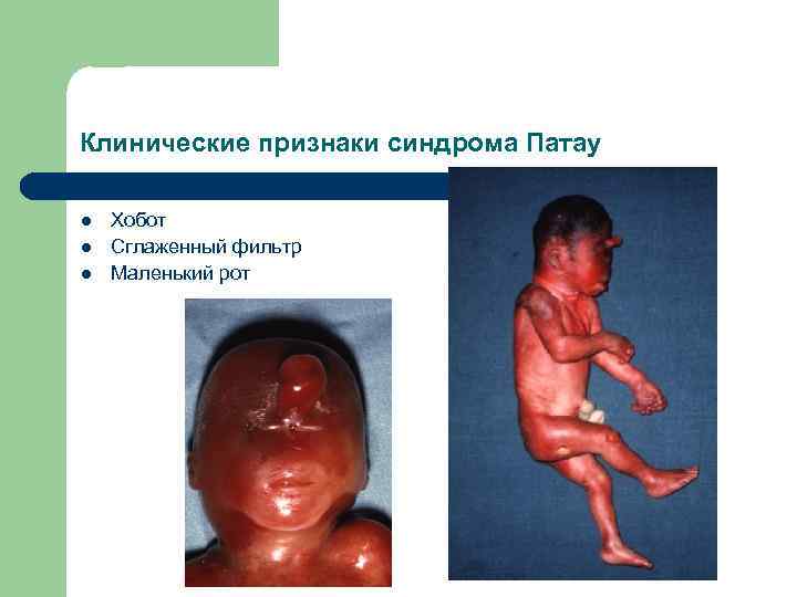 Клинические признаки синдрома Патау l l l Хобот Сглаженный фильтр Маленький рот 