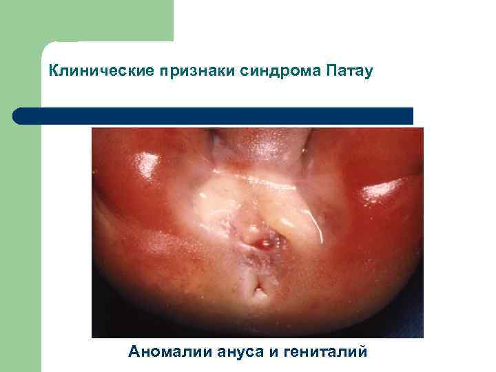 Клинические признаки синдрома Патау Аномалии ануса и гениталий 