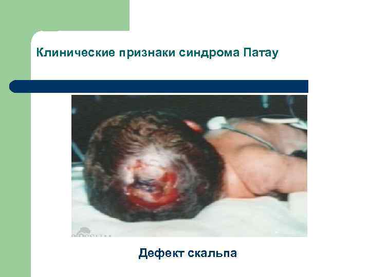 Клинические признаки синдрома Патау Дефект скальпа 