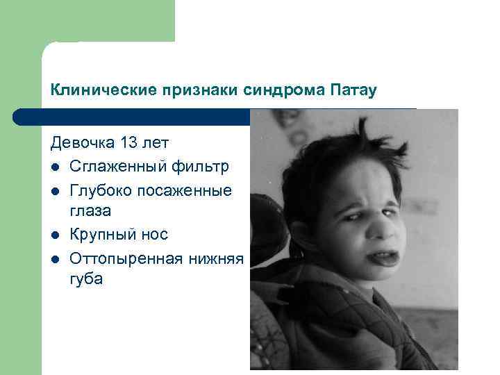Клинические признаки синдрома Патау Девочка 13 лет l Сглаженный фильтр l Глубоко посаженные глаза