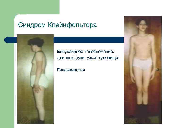 Синдром Клайнфельтера Евнухоидное телосложение: длинные руки, узкое туловище Гинекомастия 