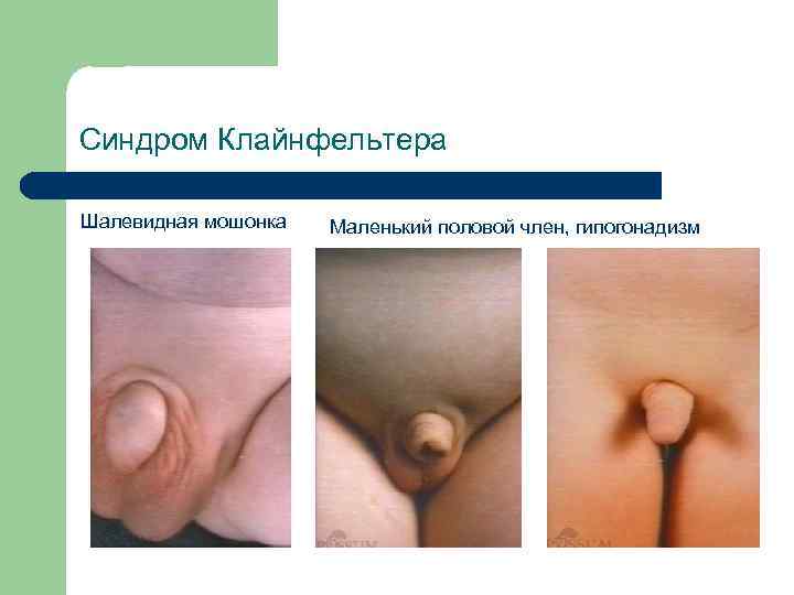 Синдром Клайнфельтера Шалевидная мошонка Маленький половой член, гипогонадизм 