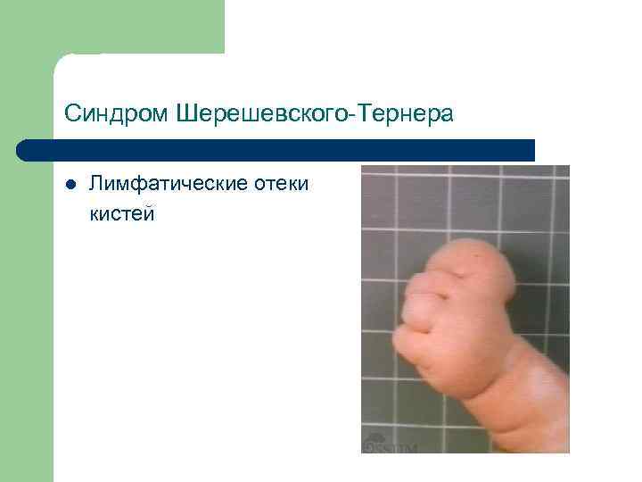 Синдром Шерешевского-Тернера Лимфатические отеки кистей l 