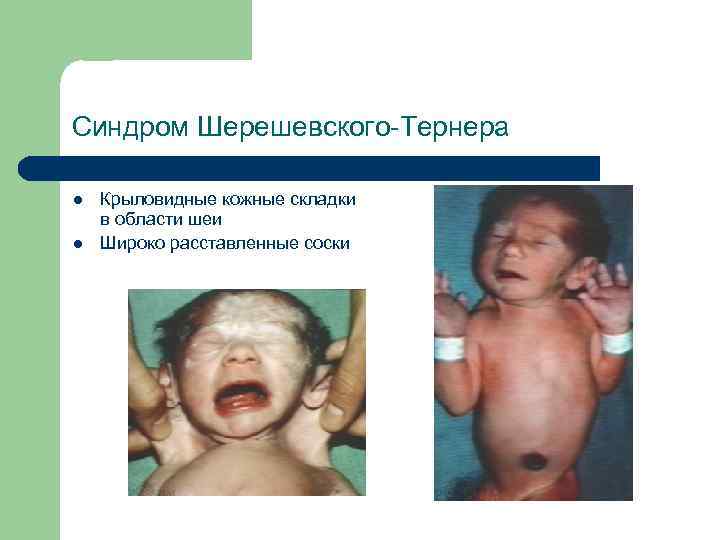 Синдром Шерешевского-Тернера l l Крыловидные кожные складки в области шеи Широко расставленные соски 