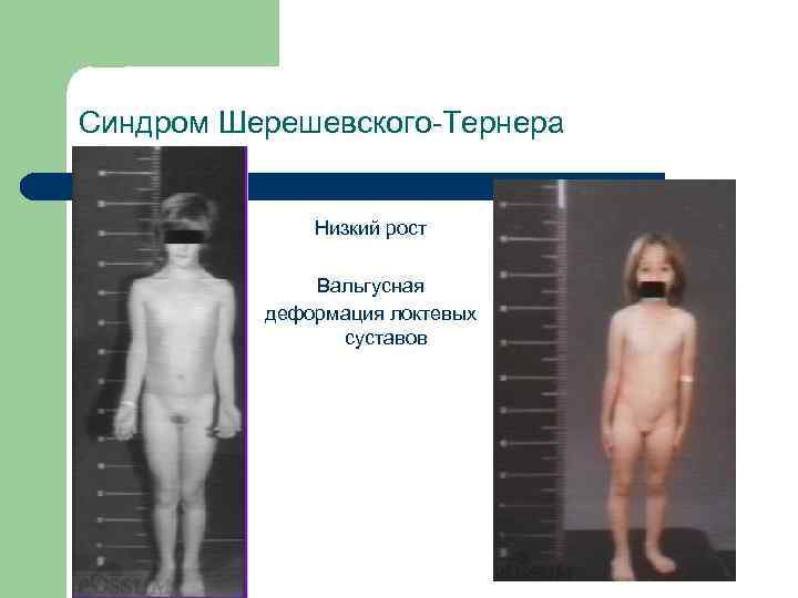 Синдром Шерешевского-Тернера Низкий рост Вальгусная деформация локтевых суставов 