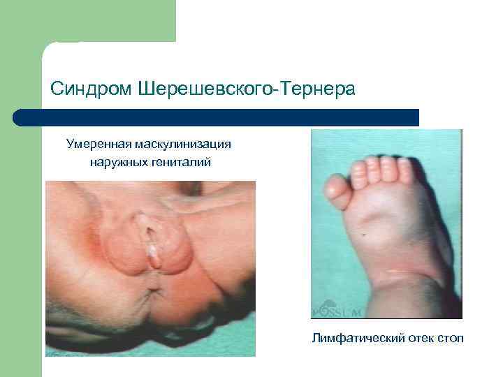 Синдром Шерешевского-Тернера Умеренная маскулинизация наружных гениталий Лимфатический отек стоп 