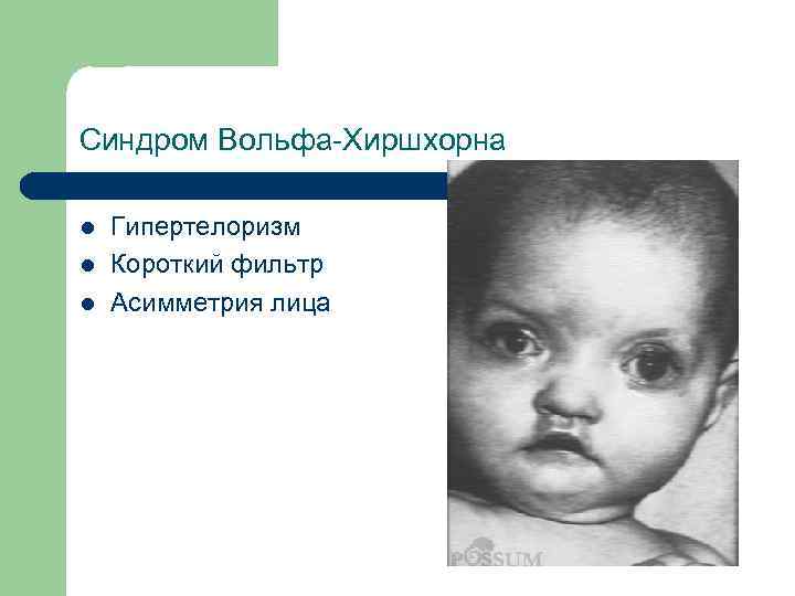Синдром Вольфа-Хиршхорна l l l Гипертелоризм Короткий фильтр Асимметрия лица 