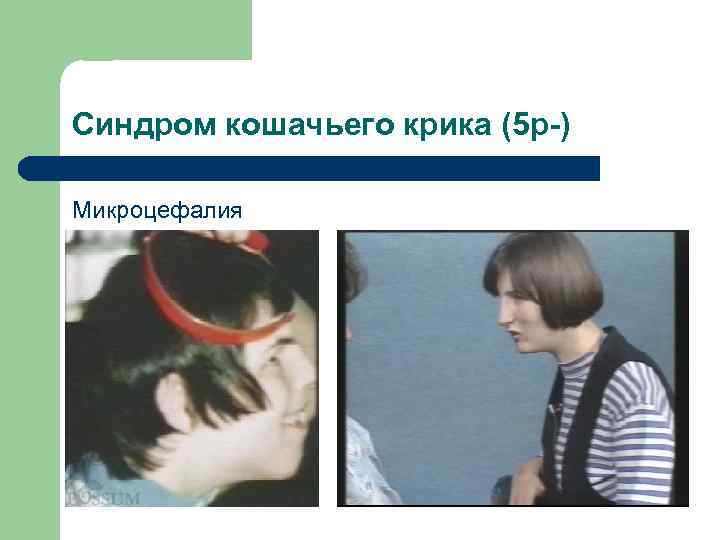 Синдром кошачьего крика (5 p-) Микроцефалия 