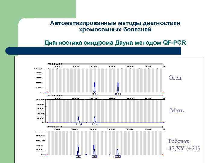 Автоматизированные методы диагностики хромосомных болезней Диагностика синдрома Дауна методом QF-PCR Отец Мать Ребенок 47,