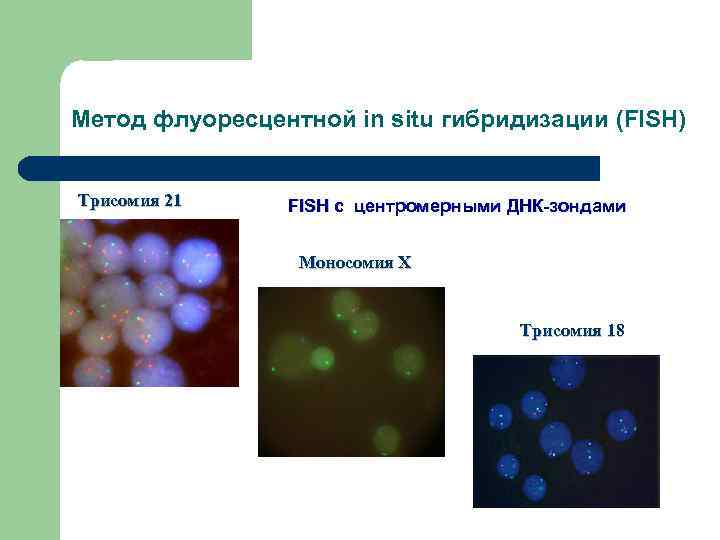 Метод флуоресцентной in situ гибридизации (FISH) Трисомия 21 FISH c центромерными ДНК-зондами Моносомия X