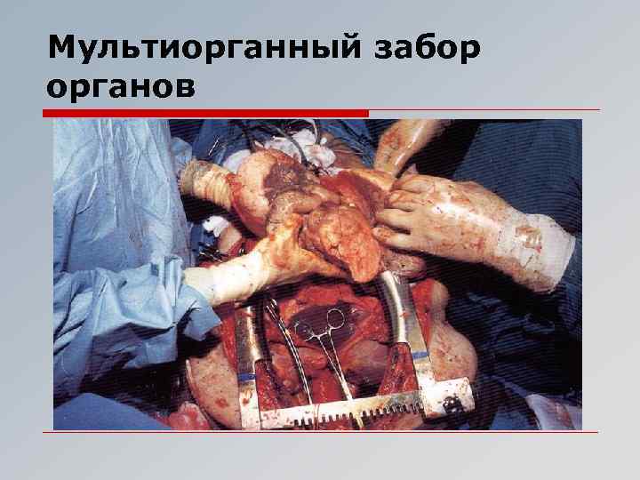Мультиорганный забор органов 