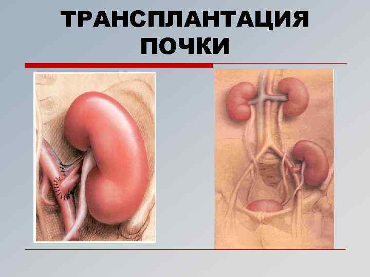 ТРАНСПЛАНТАЦИЯ ПОЧКИ 