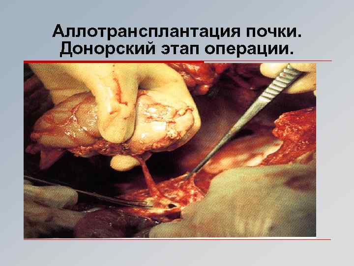 Аллотрансплантация почки. Донорский этап операции. 