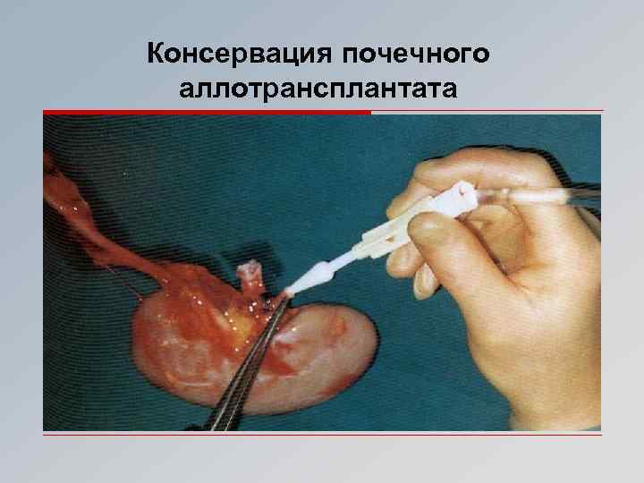 Консервация почечного аллотрансплантата 