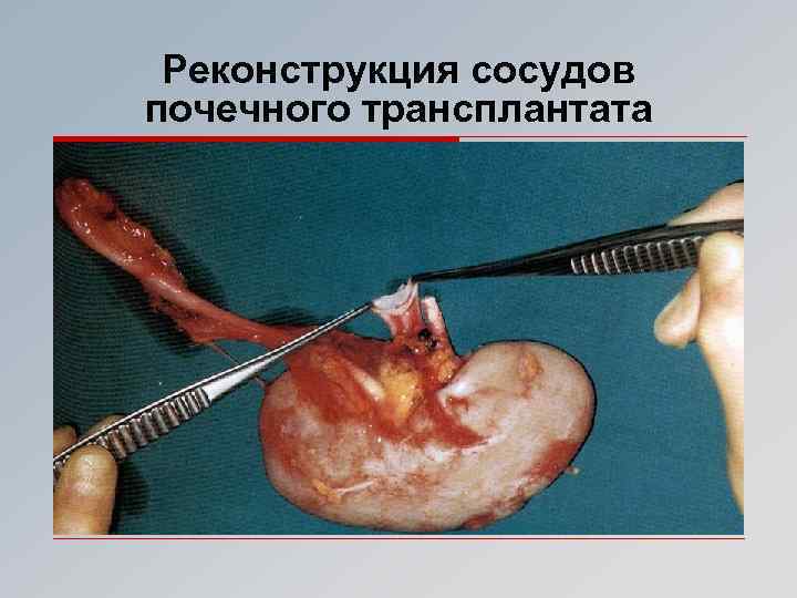 Реконструкция сосудов почечного трансплантата 