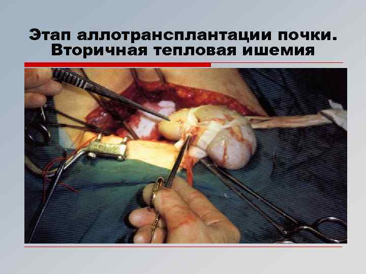 Этап аллотрансплантации почки. Вторичная тепловая ишемия 