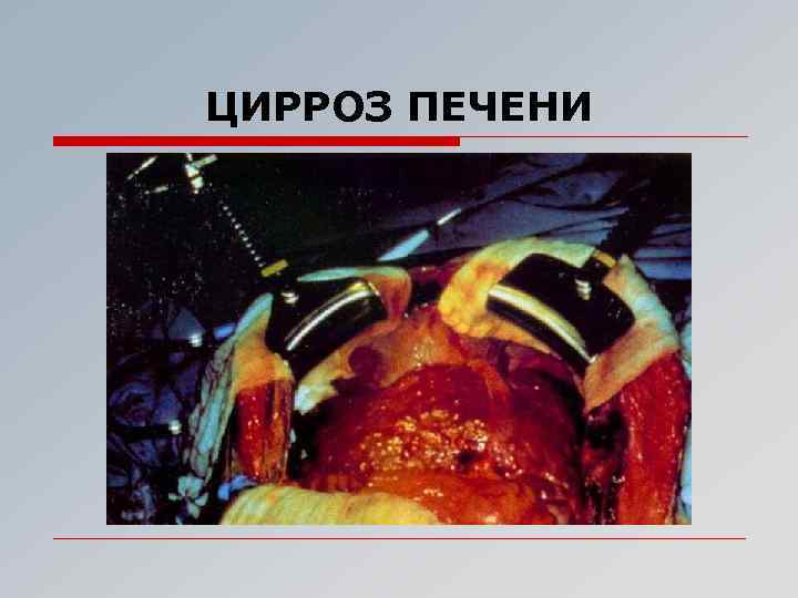 ЦИРРОЗ ПЕЧЕНИ 