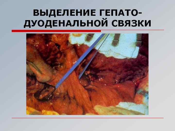 ВЫДЕЛЕНИЕ ГЕПАТОДУОДЕНАЛЬНОЙ СВЯЗКИ 