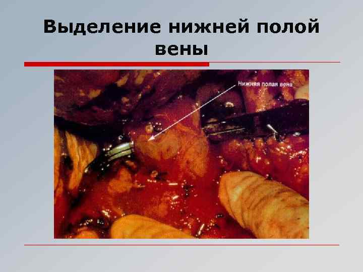 Выделение нижней полой вены 