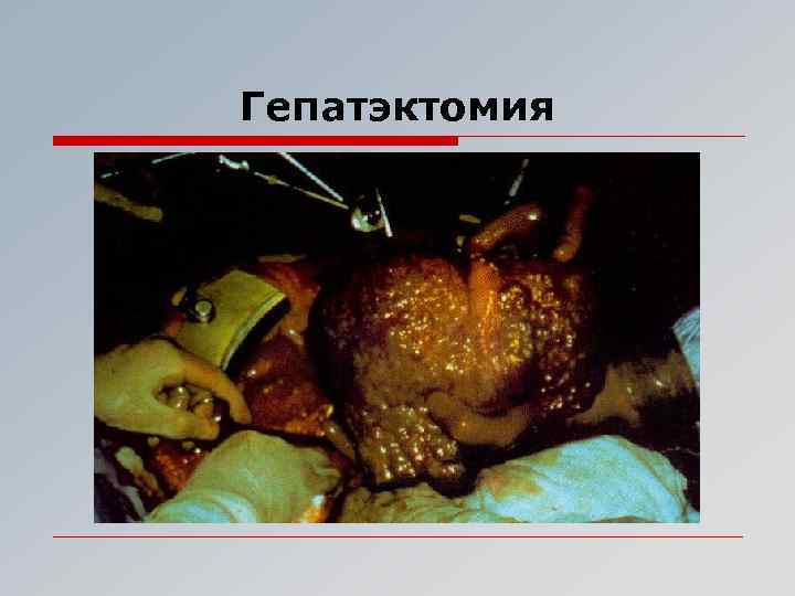 Гепатэктомия 