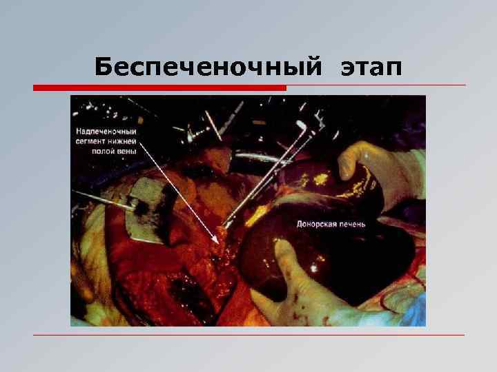 Беспеченочный этап 