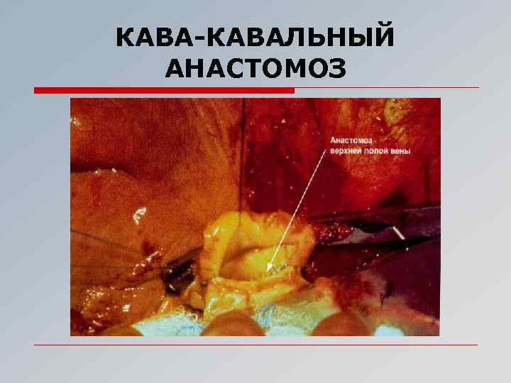 КАВА-КАВАЛЬНЫЙ АНАСТОМОЗ 