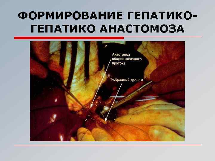 ФОРМИРОВАНИЕ ГЕПАТИКО АНАСТОМОЗА 