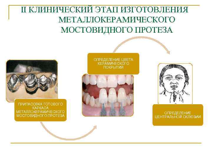 II КЛИНИЧЕСКИЙ ЭТАП ИЗГОТОВЛЕНИЯ МЕТАЛЛОКЕРАМИЧЕСКОГО МОСТОВИДНОГО ПРОТЕЗА ОПРЕДЕЛЕНИЕ ЦВЕТА КЕРАМИЧЕСКОГО ПОКРЫТИЯ ПРИПАСОВКА ГОТОВОГО КАРКАСА