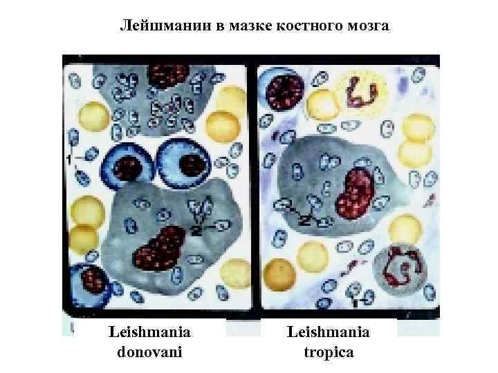 Лейшмании в мазке костного мозга Leishmania donovani Leishmania tropica 