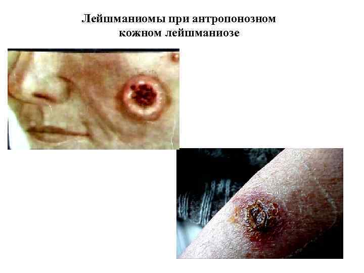 Лейшманиомы при антропонозном кожном лейшманиозе 