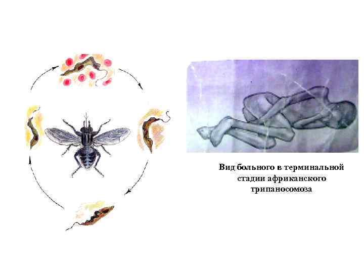 Вид больного в терминальной стадии африканского трипаносомоза 
