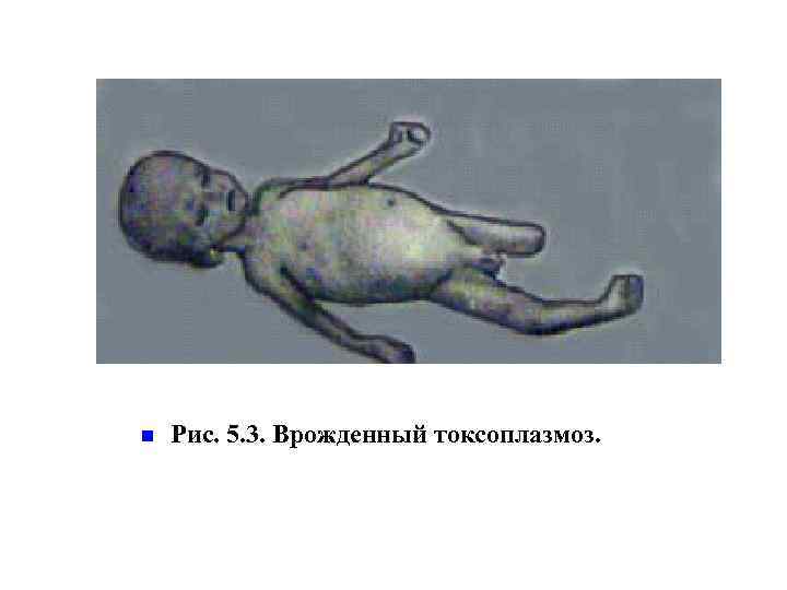 n Рис. 5. 3. Врожденный токсоплазмоз. 