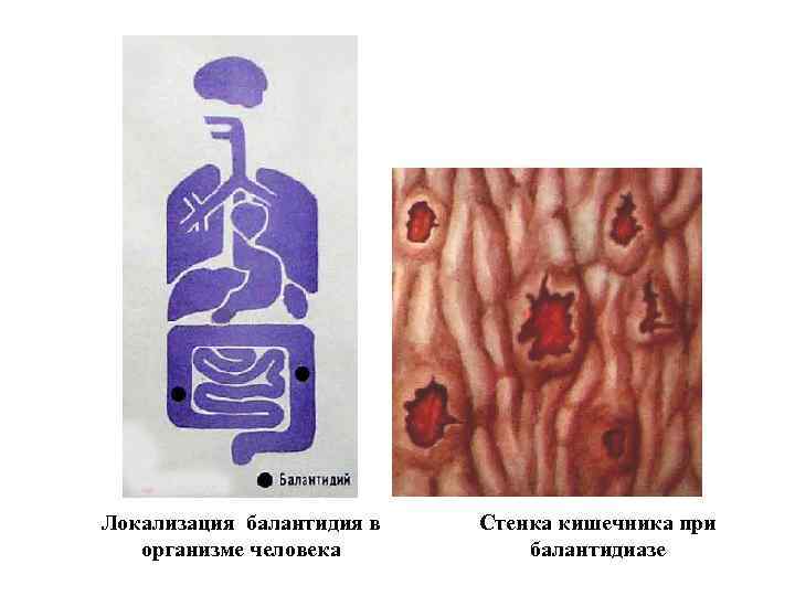 Локализация балантидия в организме человека Стенка кишечника при балантидиазе 