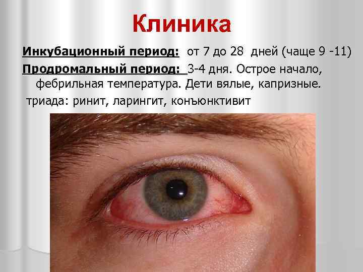Клиника Инкубационный период: от 7 до 28 дней (чаще 9 -11) Продромальный период: 3