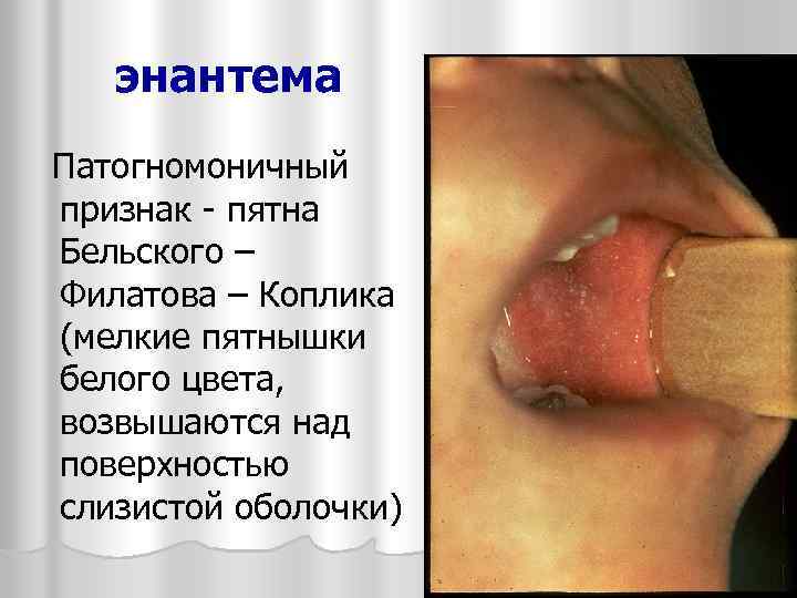 энантема Патогномоничный признак - пятна Бельского – Филатова – Коплика (мелкие пятнышки белого цвета,