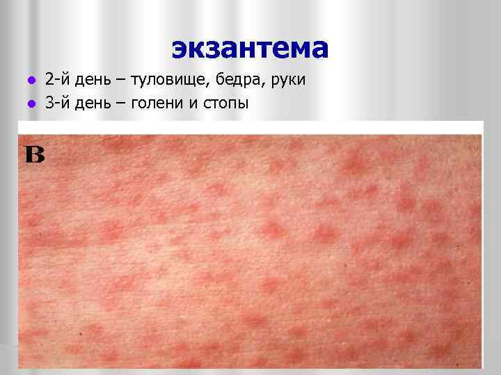экзантема 2 -й день – туловище, бедра, руки l 3 -й день – голени