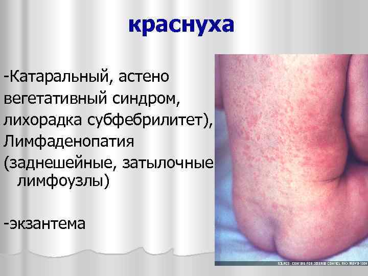 краснуха -Катаральный, астено вегетативный синдром, лихорадка субфебрилитет), Лимфаденопатия (заднешейные, затылочные лимфоузлы) -экзантема 