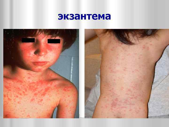 экзантема 
