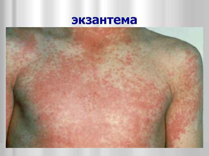 экзантема 