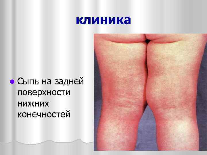 клиника l Сыпь на задней поверхности нижних конечностей 