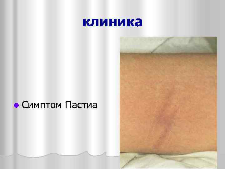 клиника l Симптом Пастиа 