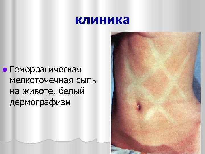 клиника l Геморрагическая мелкоточечная сыпь на животе, белый дермографизм 