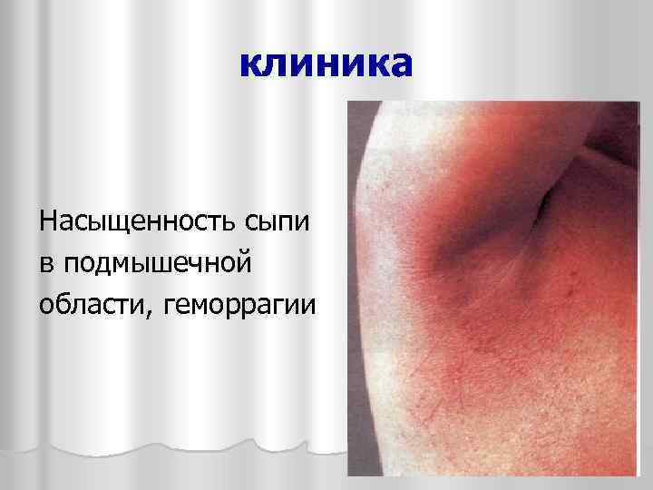 клиника Насыщенность сыпи в подмышечной области, геморрагии 
