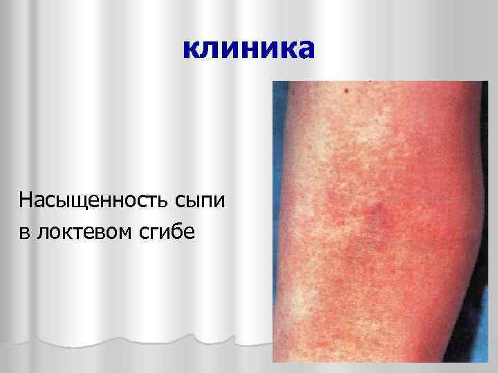 клиника Насыщенность сыпи в локтевом сгибе 